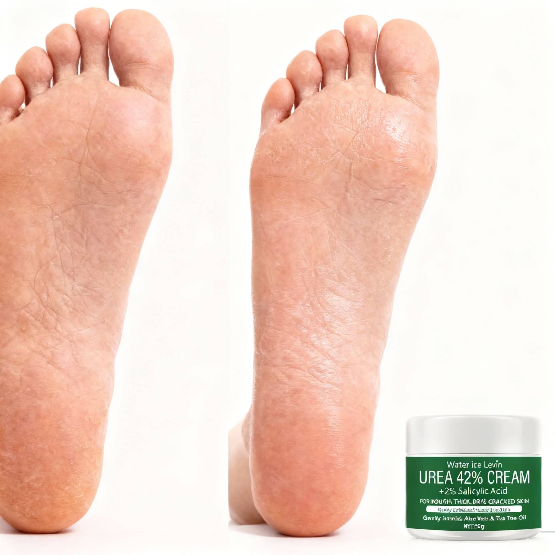 Crema piedi Urea 42%, trattamento intensivo per talloni screpolati, idratazione profonda, pelle secca e calli, piedi morbidi e curati