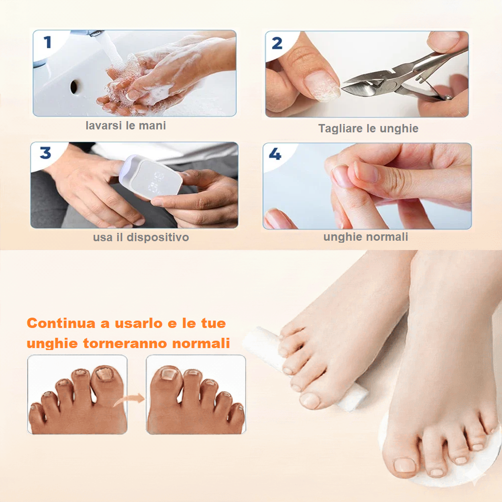 LaserNail dispositivo laser anti‑fungine per unghie dei piedi – terapia LLLT per onicomicosi, eliminazione del fungo, unghie più sane
