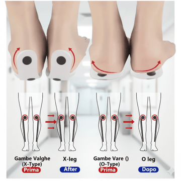 Orthotic Insoles™ – Correzione delle Gambe O/X con Semelle Ortopediche Magnetiche
